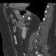 Gastric banding, slipped: CT - Computed tomography